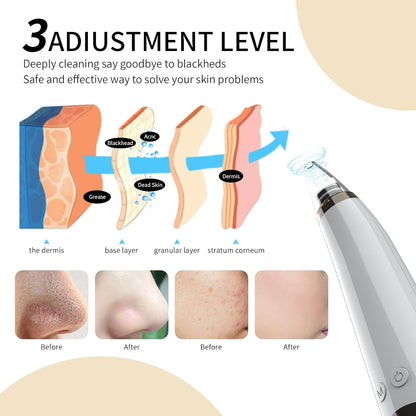 2026 Blackhead Remover Pore Vacuum Cleaner - 3 Adjustable Suction Power 6 Probes,Usb Rechargeable Blackhead Vacuum Kit Electric Acne Extractor Tool for Women